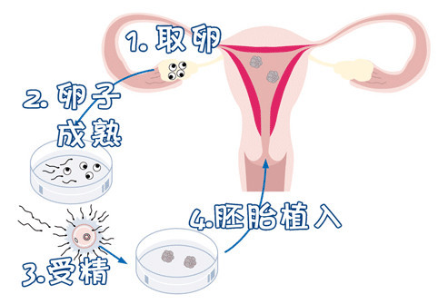 同性供卵代怀服务怎么收费